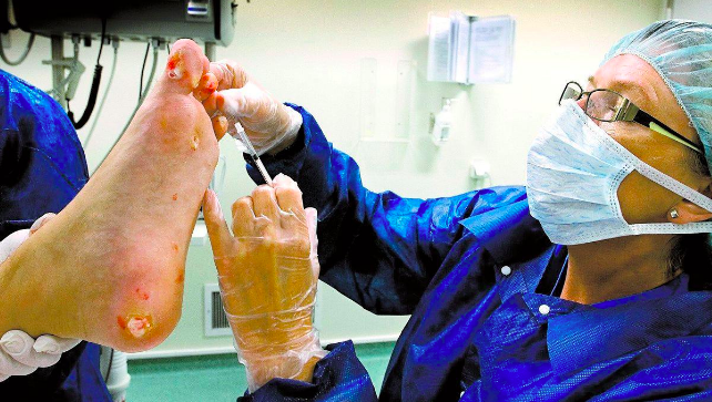 En bild på behandling av Hyperhidros med injektion av Botulinumtoxin